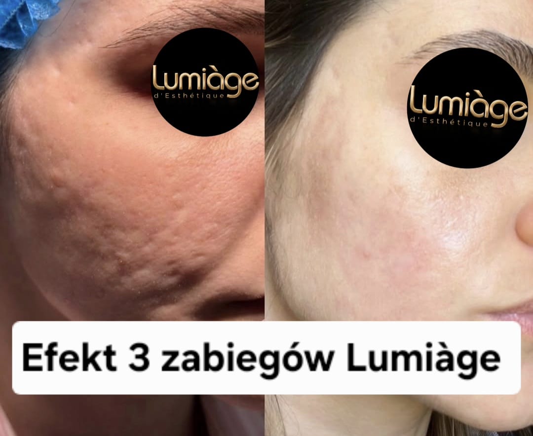 Efekt zabiegowy Lumiàge 1927 i 1550 nm 20
